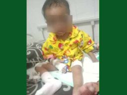 Balita di Kota Batu Dianiaya Calon Ayah Tiri, Disiksa hingga Disiram Air Panas