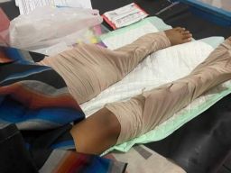 Kaki Ibu Tertimpa Tembok Roboh di Malang Akhirnya Diamputasi