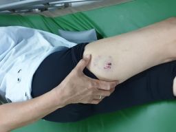 Digigit Anjing Herder, Nenek Warga Surabaya Lapor Polisi