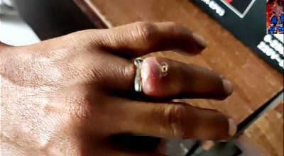 Jari Manis Pria Gresik Bengkak, Damkarla Potong Bagian Ini