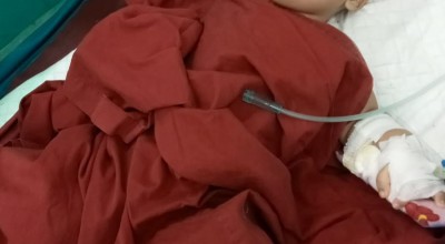 Kondisi Bayi Hidrosefalus asal Lamongan Dikabarkan Memburuk