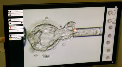 Hindari Talasemia, Lakukan Deteksi Dini & PGT-M