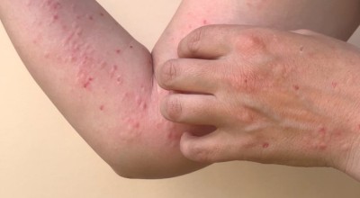 Belum Temukan Kasus Monkeypox di Jatim, Kadinkes Terbitkan SE Kewaspadaan