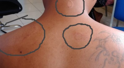 Dinkes Tuding Kunjungan Kota Batu Tinggi jadi Penyebab Kusta yang Diderita Warga