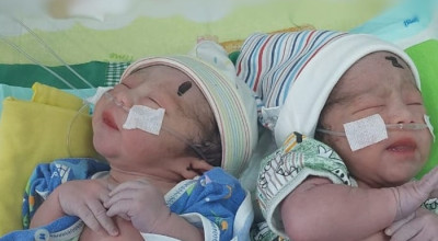 Kondisi Bayi Kembar Siam di Tulungagung Membaik, Bisa Rawat Jalan
