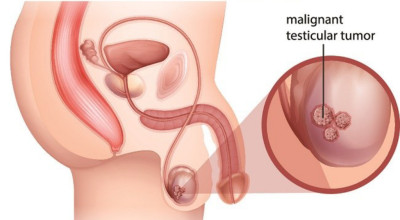 Kanker Testis Tidak Bisa Diabaikan, Kenali Gejala dan Cara Penanganannya