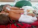 RSU dr Soetomo Tangani Bayi Kembar Siam Asal Lamongan