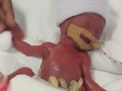13 Bulan Dirawat, Bayi Terkecil di Dunia Boleh Pulang