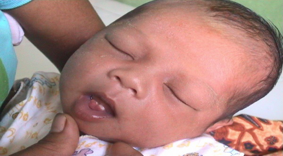 Pakar mengungkapkan penyebab dari natal teeth masih belum jelas hingga saat ini dan bukan merupakan keturunan. (Foto: Dok. Humas Unair)