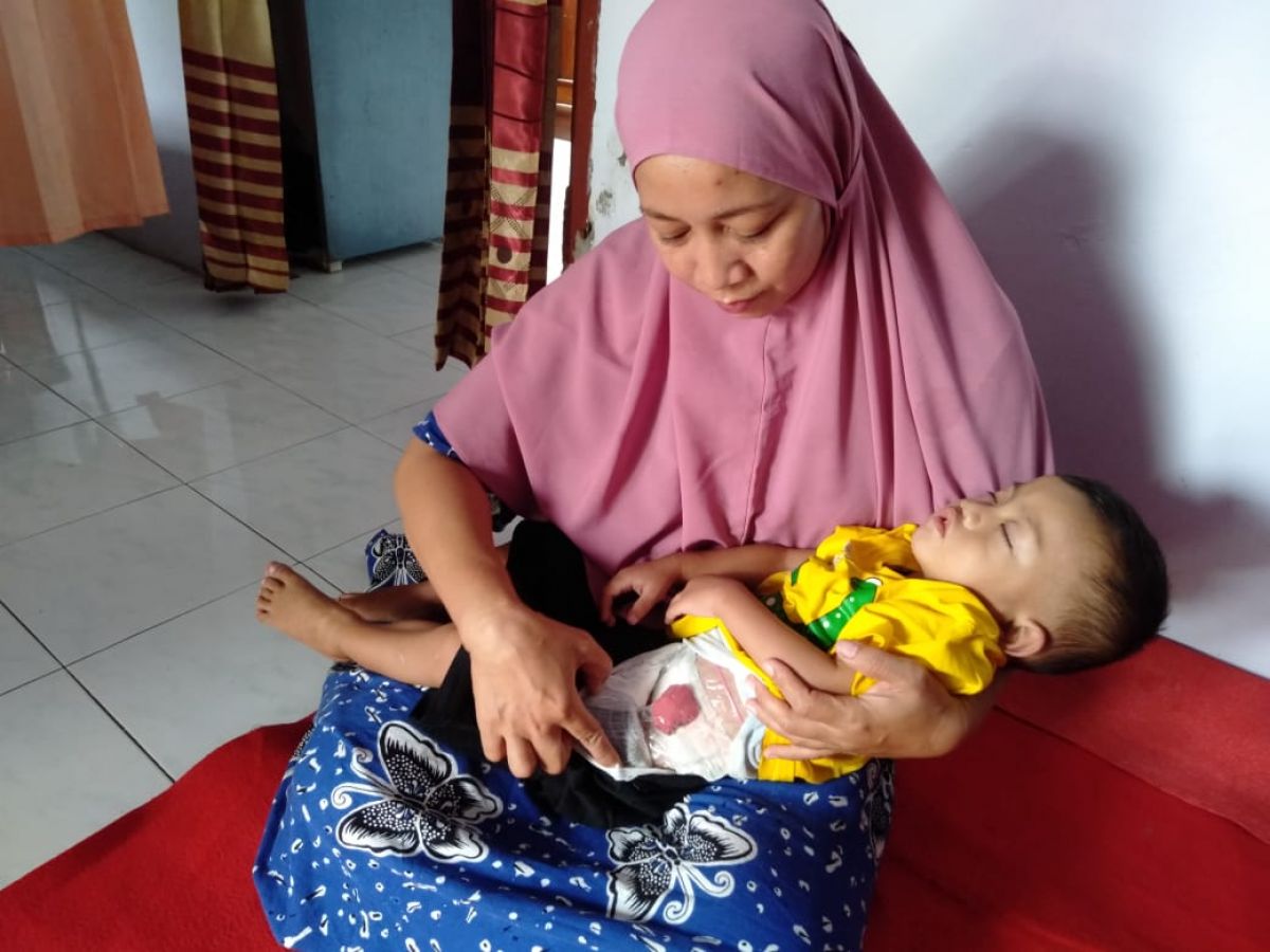 Balita di Sidoarjo Tak Punya Lubang Anus Butuh Bantuan, 2 Tahun Menunggu Operasi