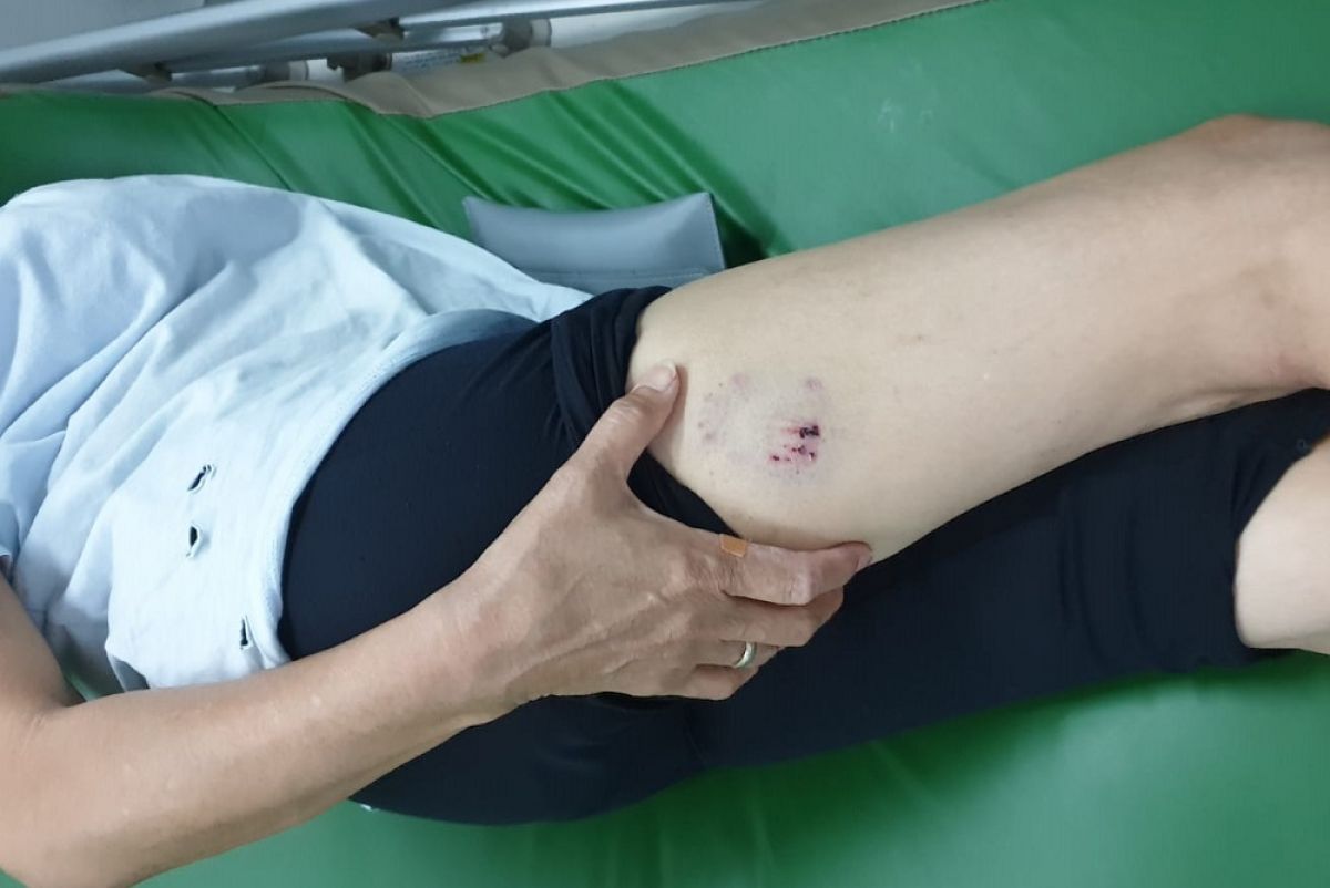 Luka bekas gigitan anjing yang dialami nenek SK. (Foto: Malik for jatimnow.com)