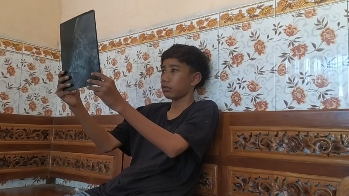 Korban Irvan Verdiansa (14) yang wajahnya mengalami luka lebam dan patah hidung menunjukkan hasil rontgen. (Foto: Elok Aprianto/jatimnow.com)