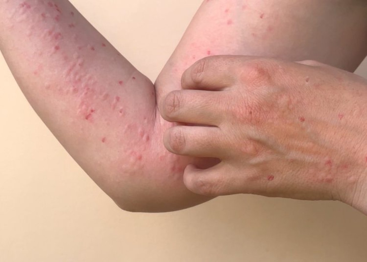 Belum Temukan Kasus Monkeypox di Jatim, Kadinkes Terbitkan SE Kewaspadaan