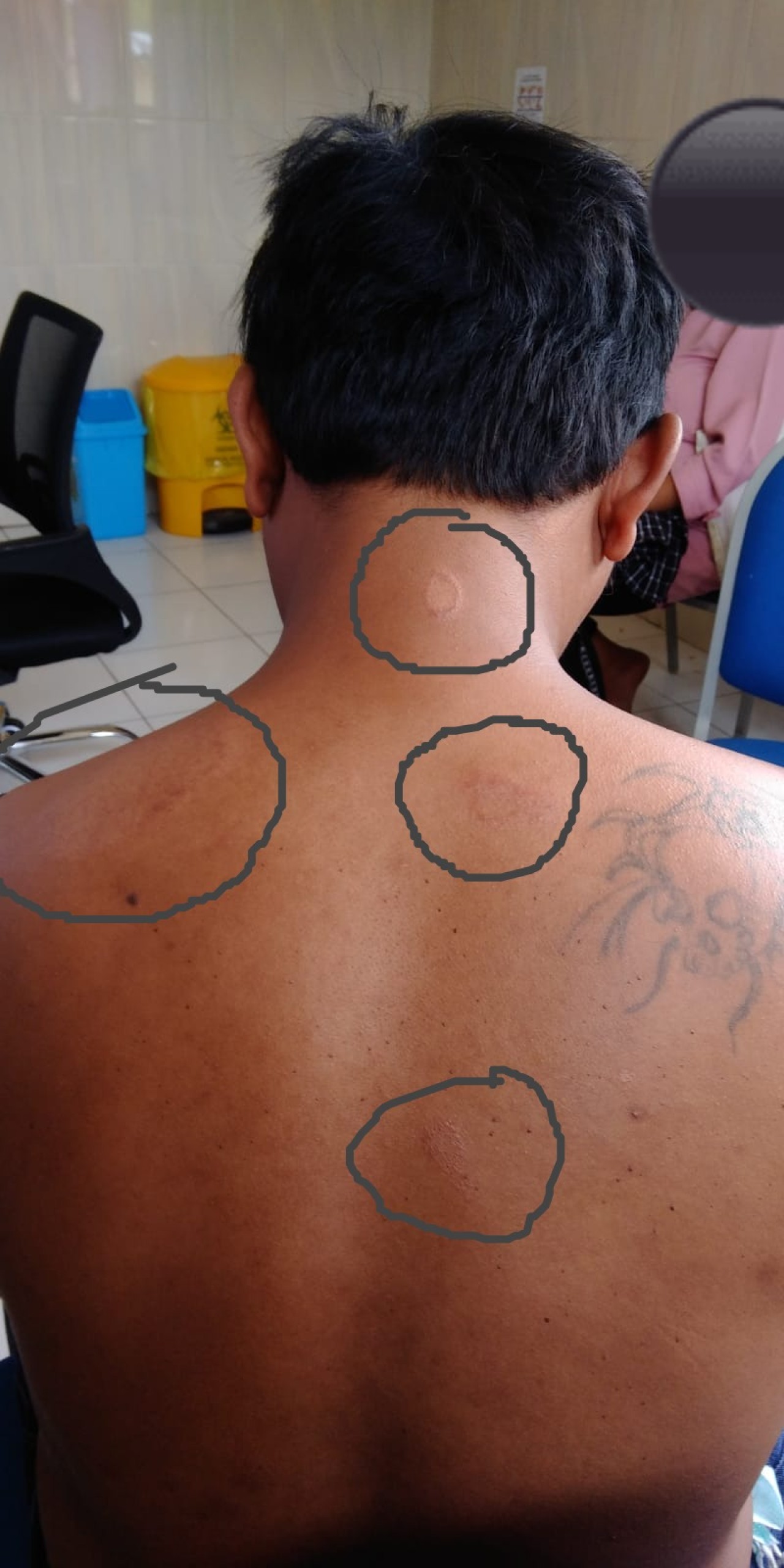 Dinkes Tuding Kunjungan Kota Batu Tinggi jadi Penyebab Kusta yang Diderita Warga