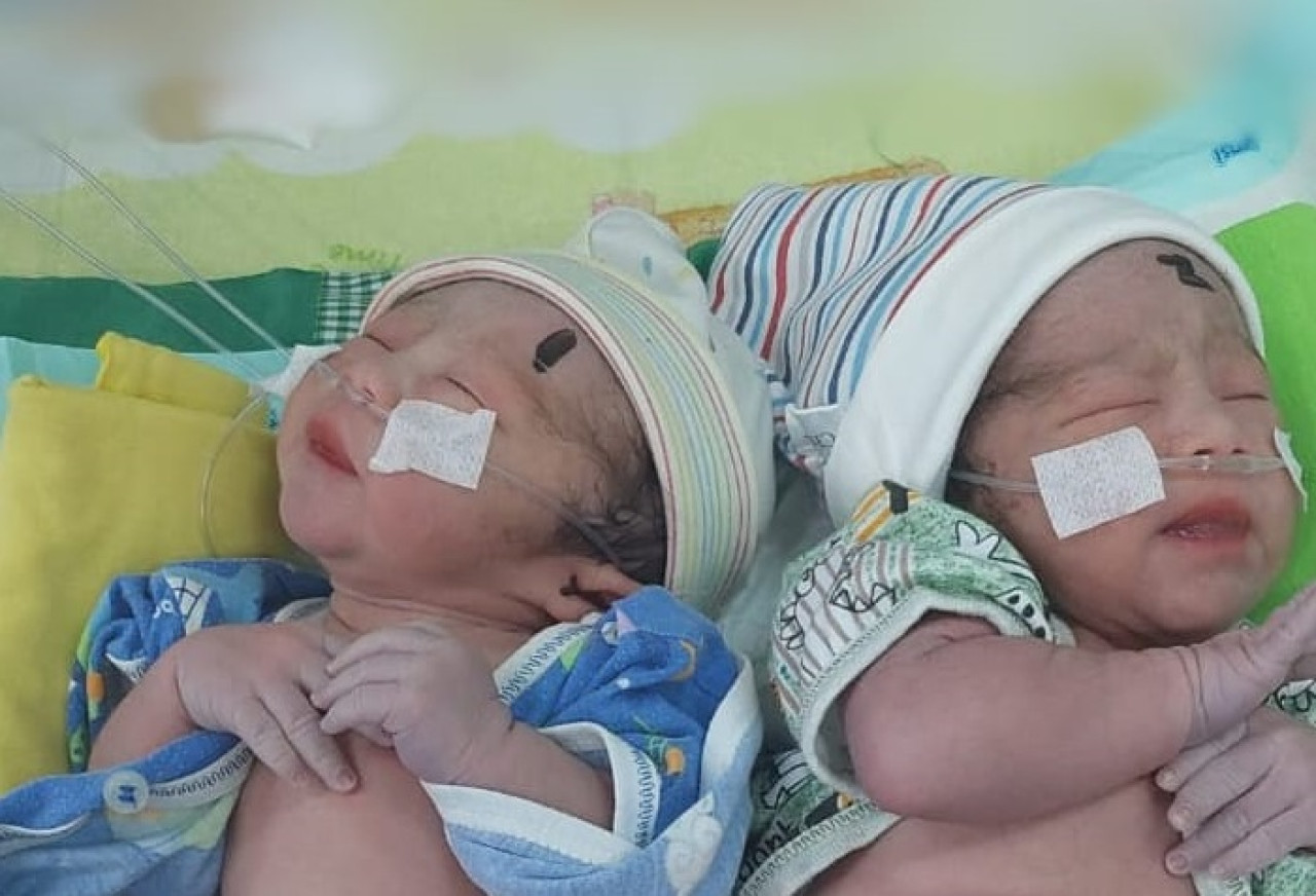 Bayi kembar siam yang menjalani perawatan di RSUD dr Iskak Tulungagung. (Foto: Dok RSUD dr Iskak Tulungagung for