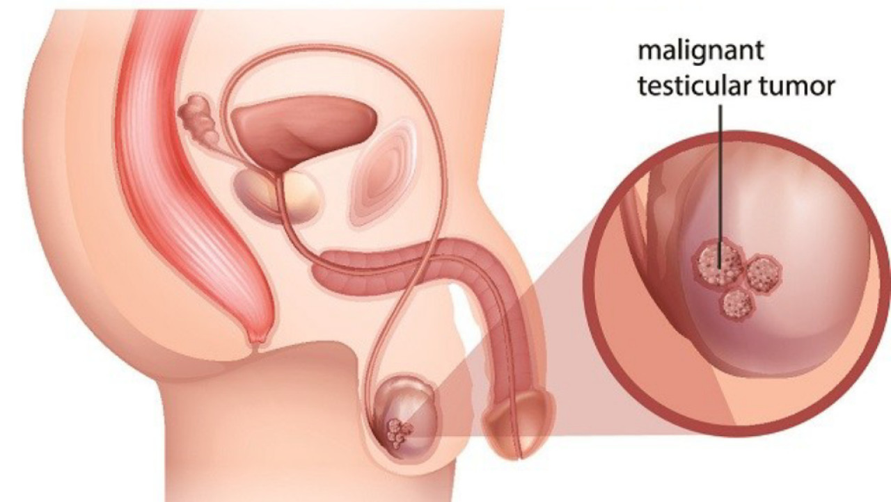 Kanker testis sering kali tidak menunjukkan gejala. Foto: Ilustrasi/Alodokter