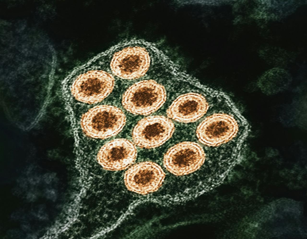 Ilustrasi campak. (Foto: National Institute of Allergy and Infectious Diseases/Unsplash)