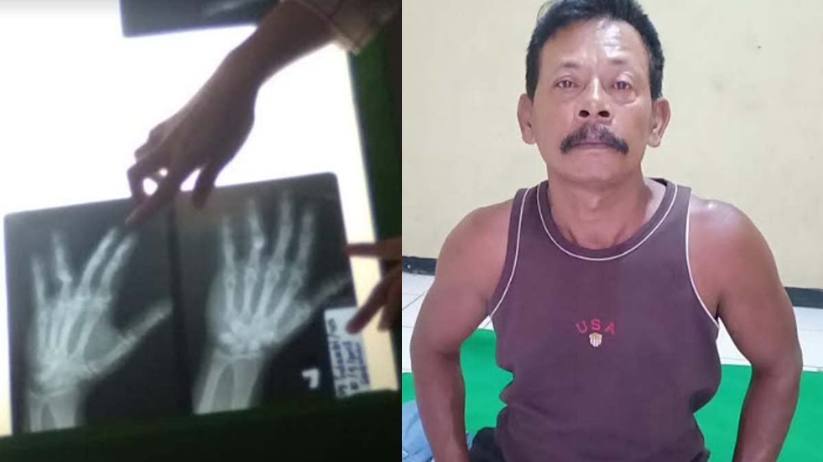 Foto rontgen tangan korban (kiri) yang patah dan pelaku yang tega aniaya adiknya (kanan)