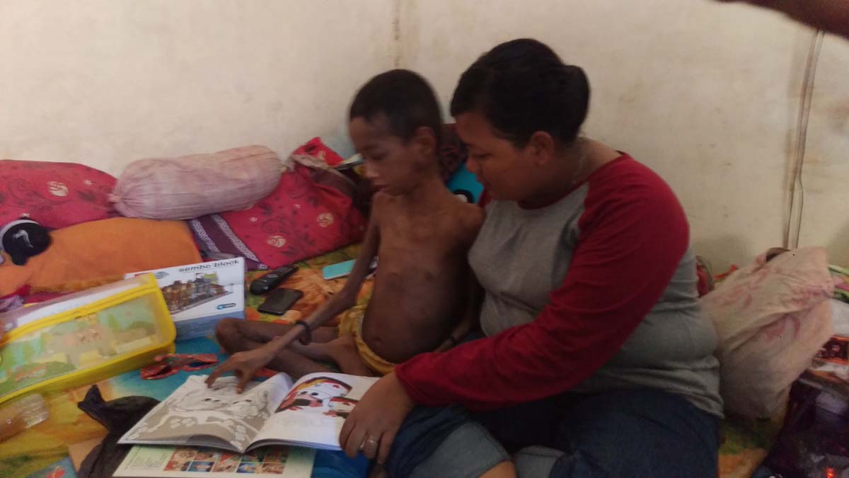 Aldi, bocah penderita gizi buruk di Surabaya