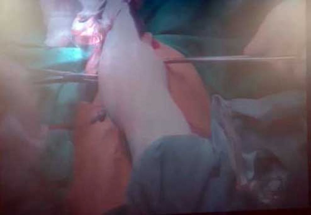 Operasi Kembar Siam asal Kendari, Dokter Pasang Plat dan Pusar Buatan