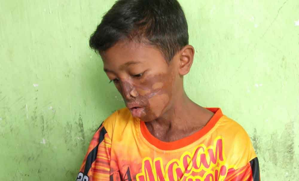 Kondisi samuel setelah 5 tahun peristiwa penyiraman air keras