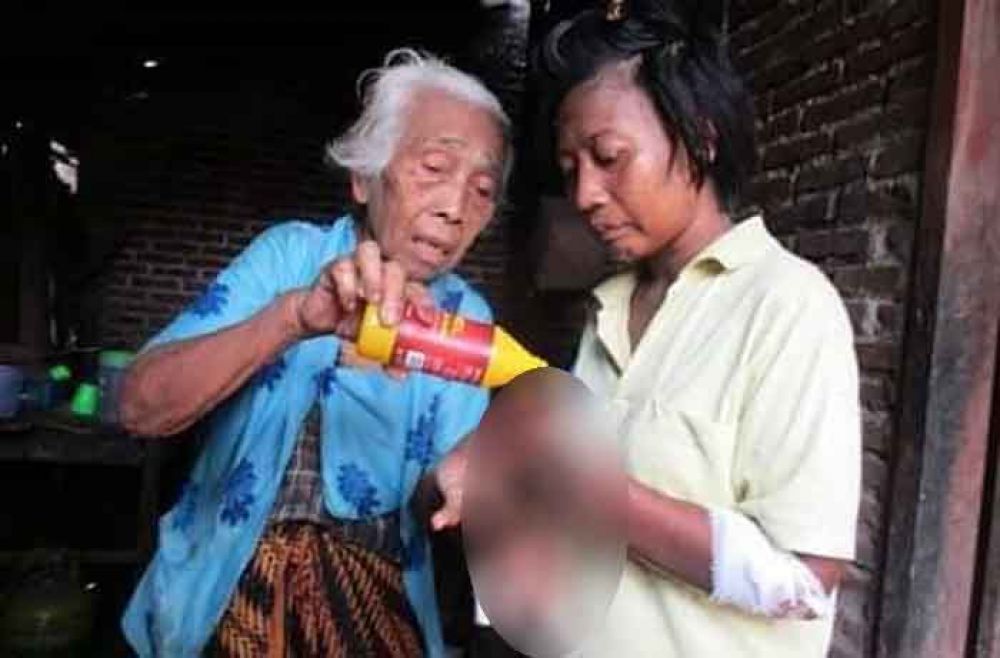 Awasi Gadis Pemakan Jari Tangan, RSJ Menur Siagakan Tim Khusus 24 Jam