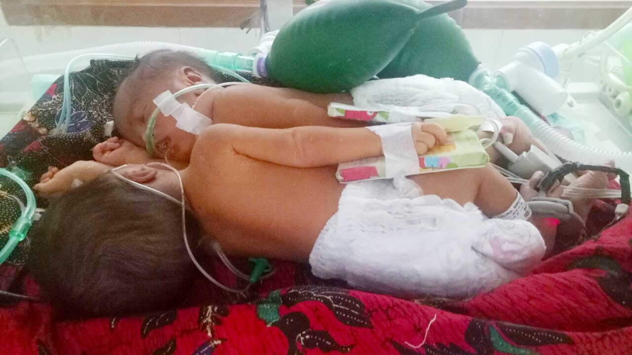 Video: RSU dr Soetomo Kembali Tangani Bayi  Kembar Siam