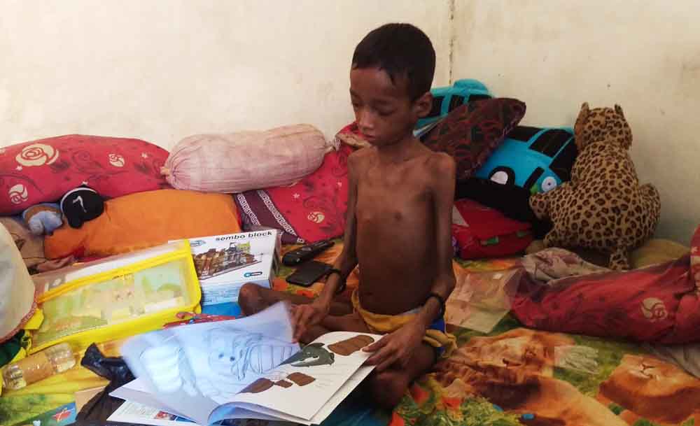 Adi Slamet Nugroho (10)  anak dengan dugaan gizi buruk di Surabaya